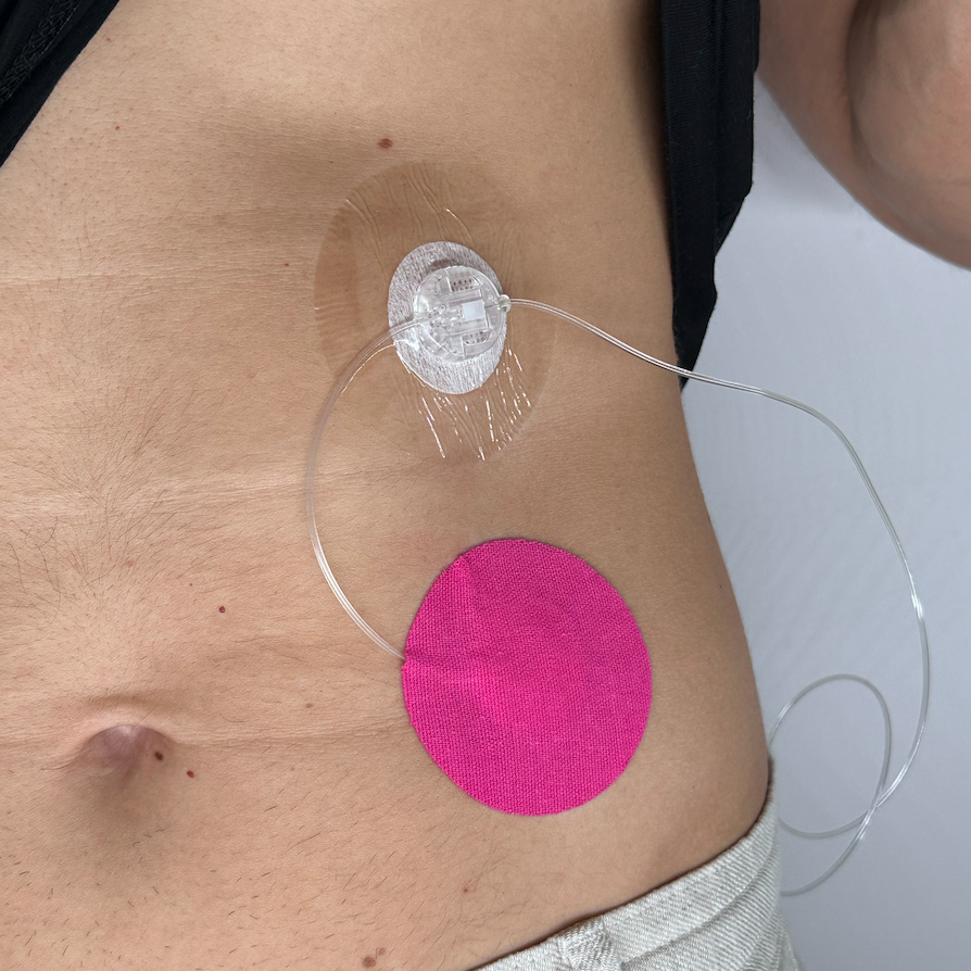 PROTETTORE CATETERE POMPA INSULINA 20pz | Compatibile con tutti i cateteri doppi | Rosa
