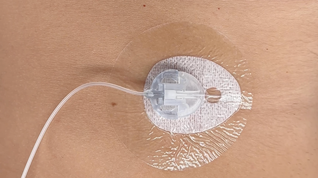 Sensor de diabetes colocado