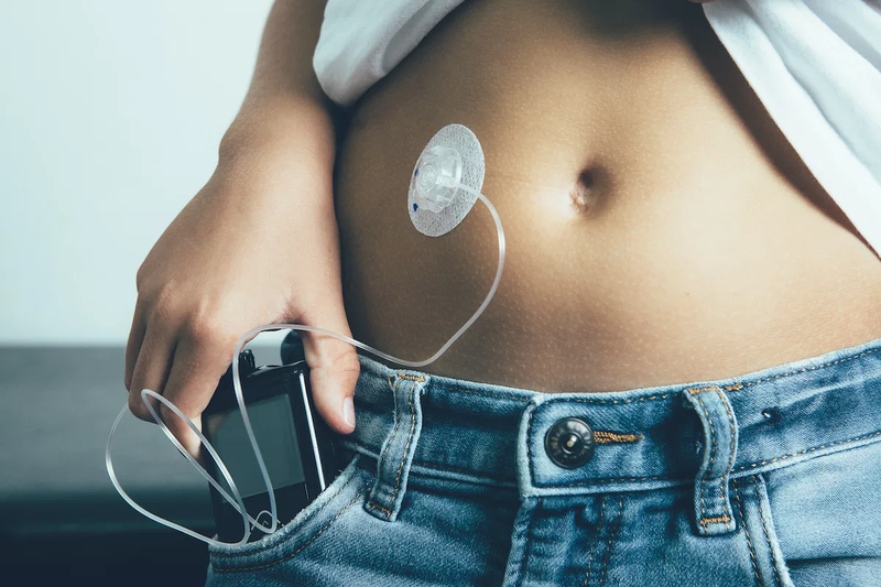 In which cases should an insulin pump be used?