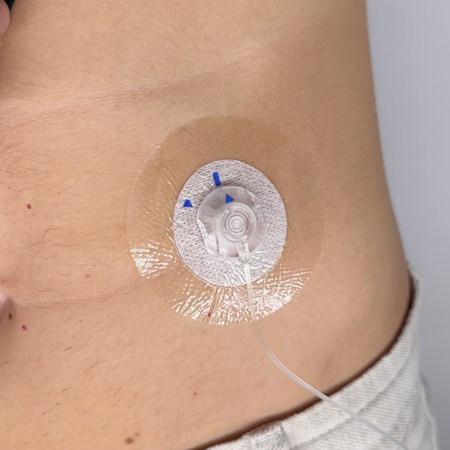 INSULIN PUMP CATHETER PROTECTOR 10pc | Transparent