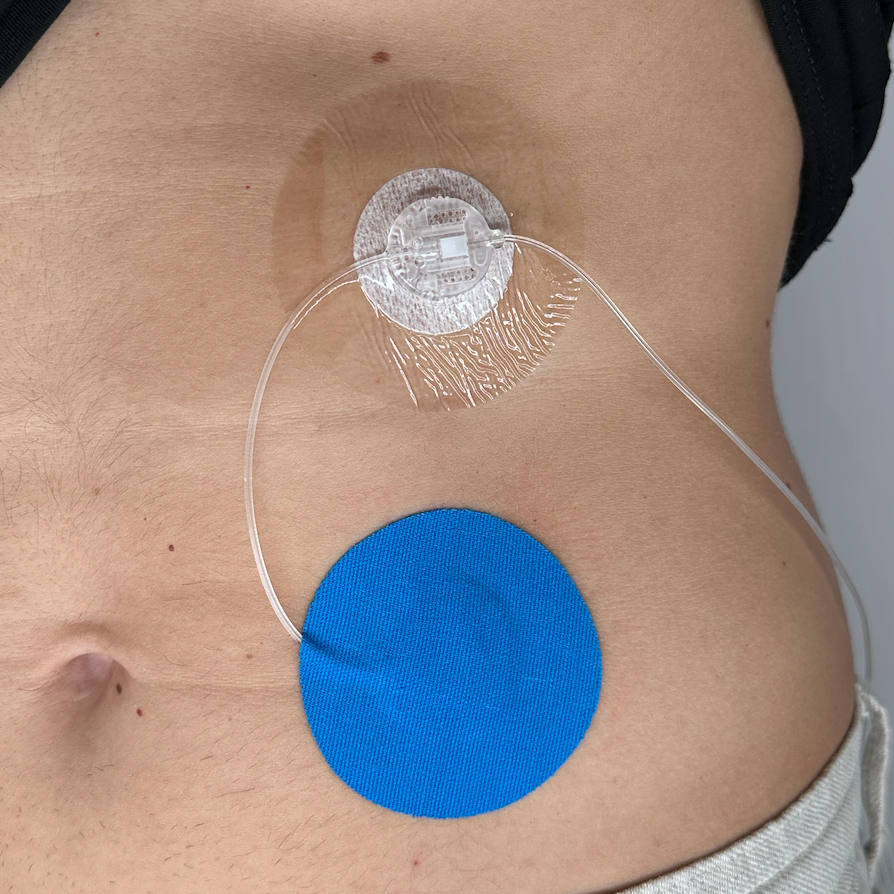 INSULIN PUMP CATHETER PROTECTOR 20pc | Blue